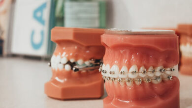2030's Smile Standards: Are Today's Veneers Tomorrow's Braces?