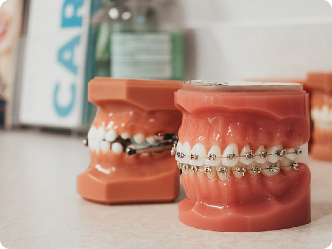 2030's Smile Standards: Are Today's Veneers Tomorrow's Braces?
