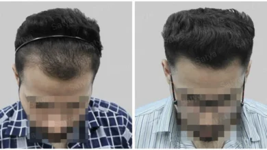 Is Getting a Hair Transplant in Dubai the Right Choice for You?