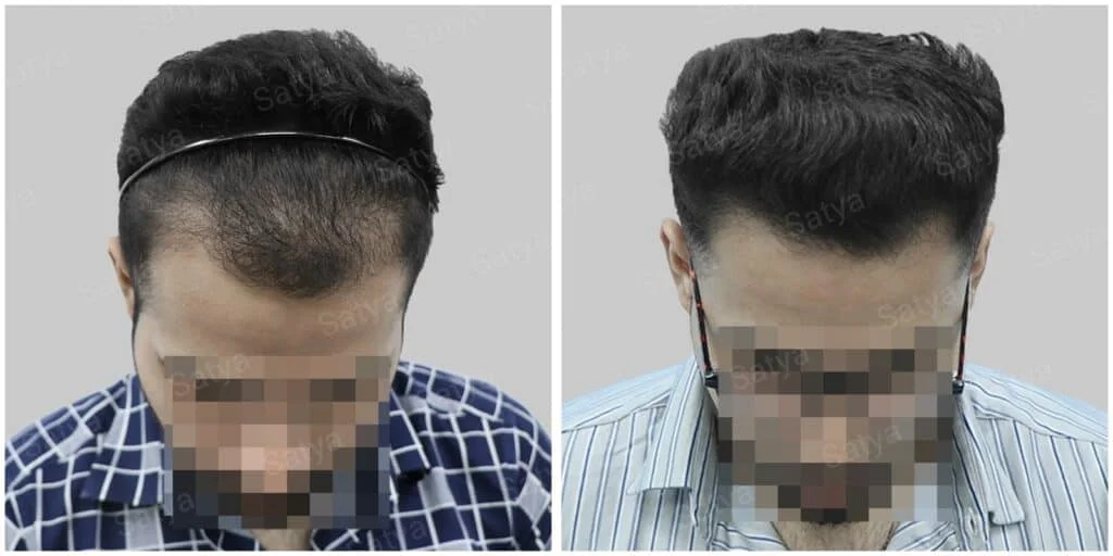 Is Getting a Hair Transplant in Dubai the Right Choice for You?